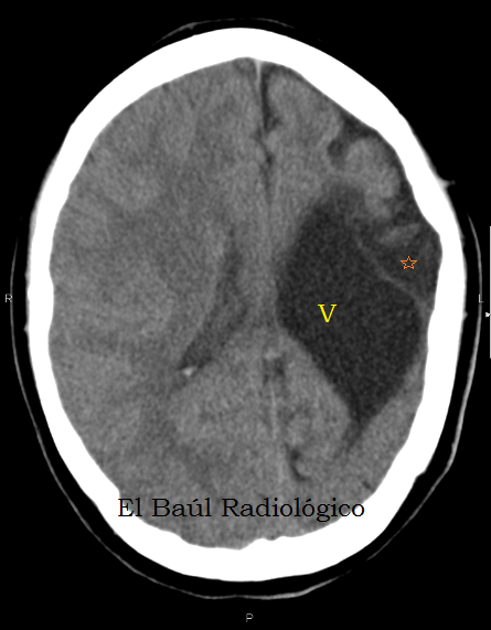 encefalomalacia cerebral